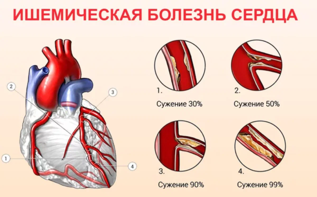 Состояние при сосудистых заболеваниях